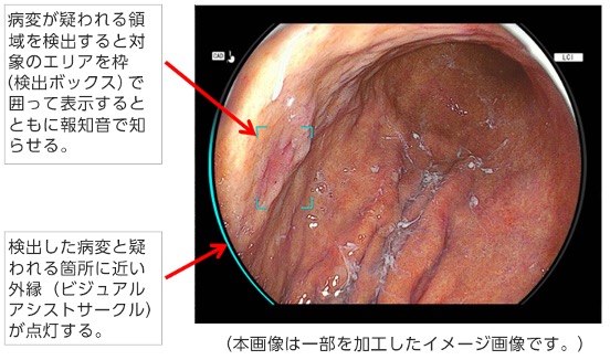 胃がん・食道扁平上皮がん疑い領域をリアルタイムに検出