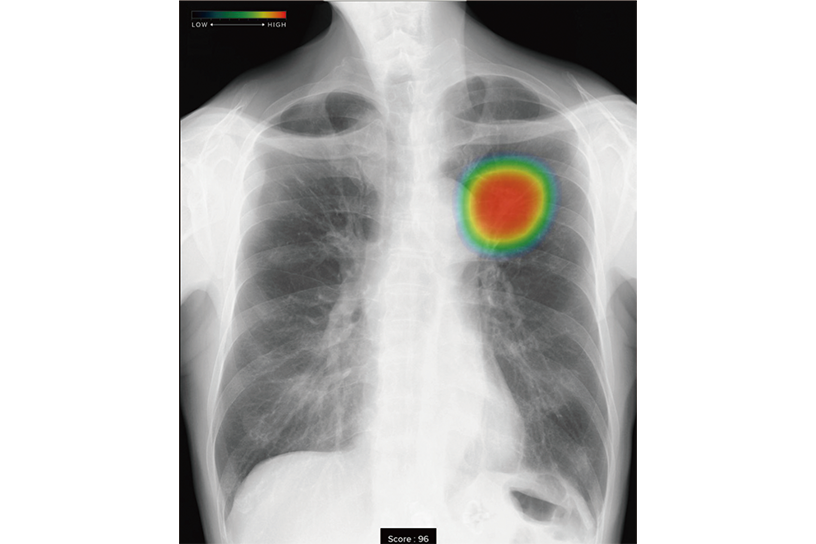 胸部X線画像病変検出ソフトウェア「CXR-AID」